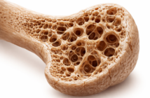 Opole bada kości. Rusza kolejna edycja bezpłatnej profilaktyki osteoporozy